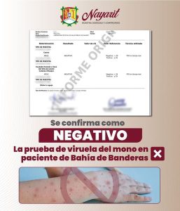 Descartan caso de viruela del mono en Bahía de Banderas. Nayarit sigue sin registrar casos tras resultados negativos